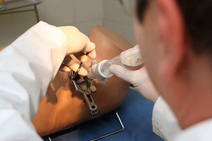 Aborto por aspiración